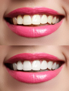 Teeth Whitening Tips Lincoln CA